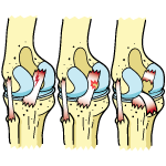 PCL Tear Grades 1-3 PCL Tear Grades 1-3