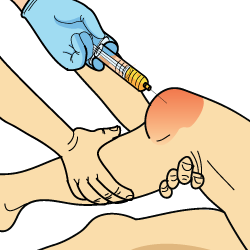 PCL Cortisone Treatment PCL Cortisone Treatment