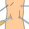 Arthroscopic Procedure Arthroscopic Procedure