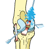 PCL Repair PCL Repair