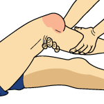 PCL Tear Exam PCL Tear Exam