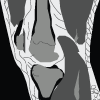 PCL Tear MRI PCL Tear MRI