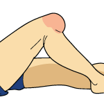 PCL Tear Signs and Symptoms PCL Tear Signs and Symptoms